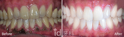 牙龈美白 施术前后对比