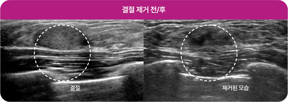 맘모톰 시술사례