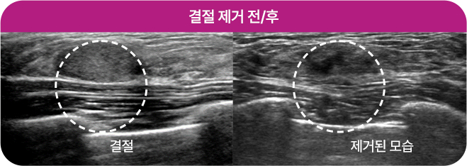 맘모톰 시술사례