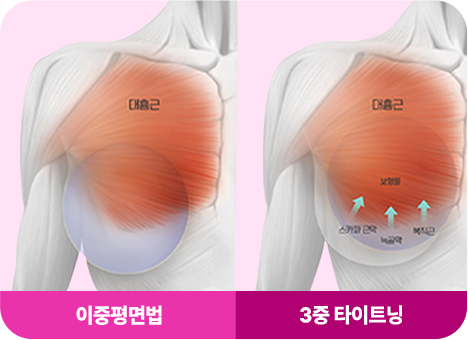 아이디병원 - id만의 독자적인 3중 타이트닝 기법으로 가슴골을 더욱 모아주고 보형물 빠짐 걱정 없이 잡아줍니다 - 가슴