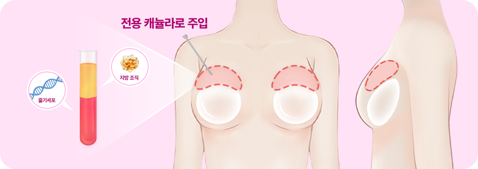 부스트업가슴성형