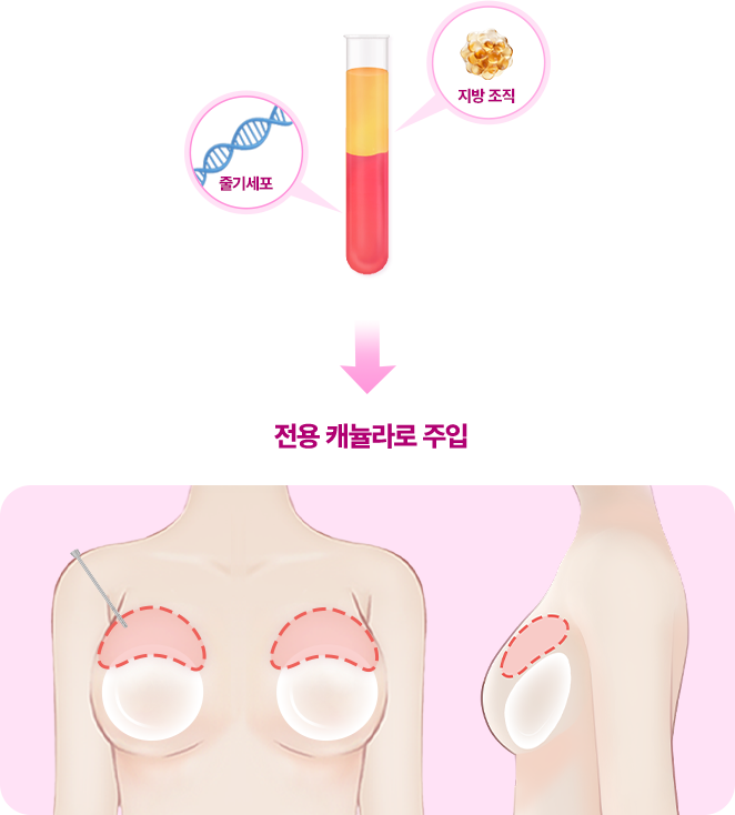 부스트업가슴성형