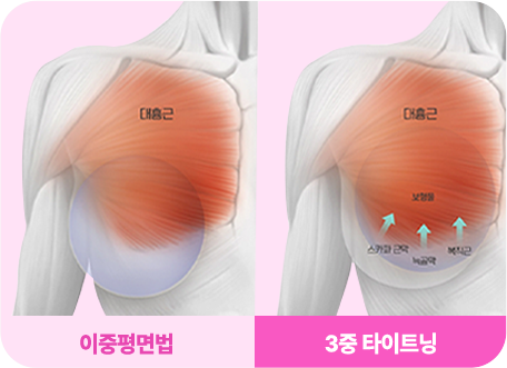3중 타이트닝 기법