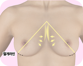 피치(복숭아) 절개법