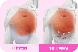 3중 타이트닝 기법