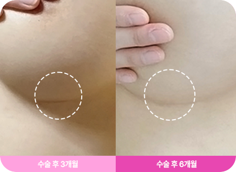 흉터 최소화