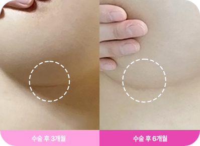 흉터 최소화