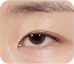 01 비대칭,안검하수 정확한 원인 파악