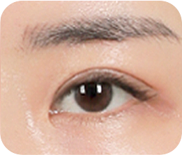 03 비대칭,짝눈 교정으로 더 크고 예뻐진 눈 완성!