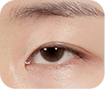 01 비대칭,안검하수 정확한 원인 파악
