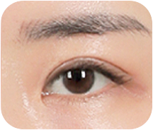 03 비대칭,짝눈 교정으로 더 크고 예뻐진 눈 완성!