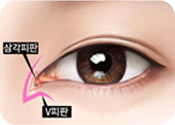 V자 형태로 박리