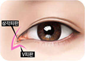 V자 형태로 박리