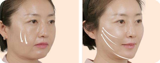 탄탄한 V라인
