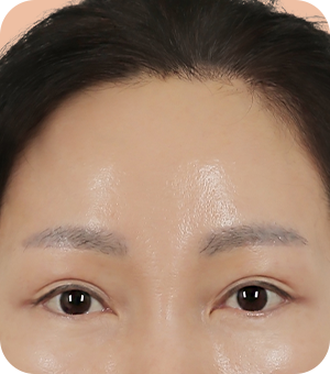 흉터 걱정 없이 또렷한 인상