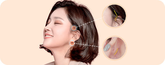 리프팅 효과는 보여도 흉터는 숨겨야지!