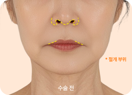 하이브리드 입술리프팅