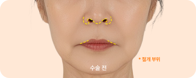 하이브리드 입술리프팅