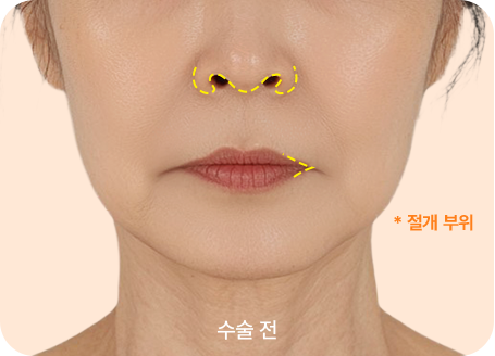 입술/입꼬리 더블 리프팅