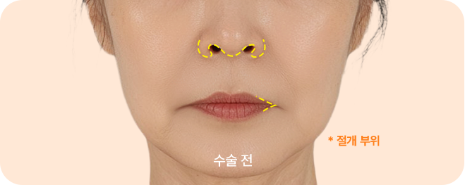 입술/입꼬리 더블 리프팅