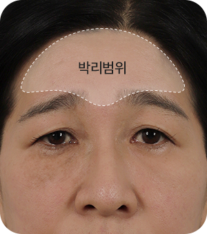 이마, 관자놀이, 눈썹, 미간 근육까지 박리 후 고정