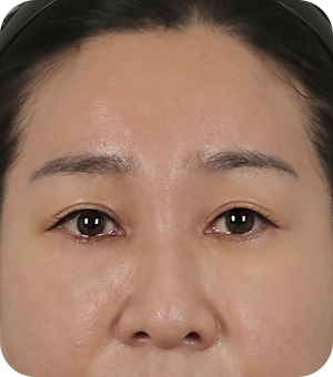 흉터 없이 깊은 이마주름, 처진 눈매, 눈썹, 미간 주름까지 올인원 개선!