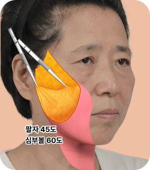 처짐 정도에 따라 id 만의 기술력으로 리프팅 후 3중 고정 