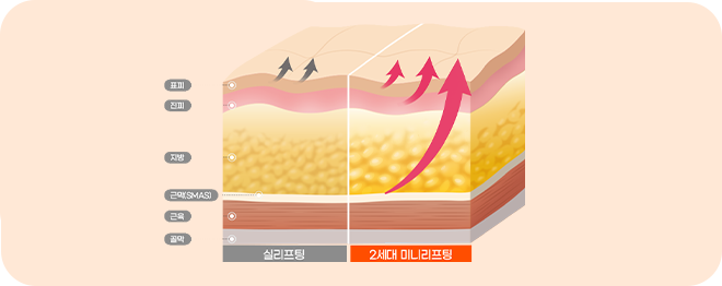 파워 미니리프팅 이미지 1