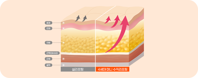 파워 미니리프팅 이미지 1