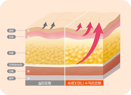 파워 미니리프팅 이미지 1