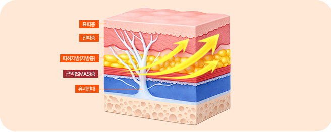파워 미니리프팅 이미지 2