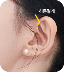 헤어라인 안쪽, 히든절개