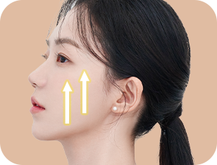 헤어라인 안쪽, 히든절개