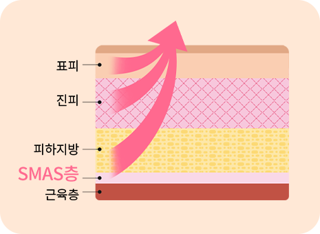 수술당일 즉시효과!