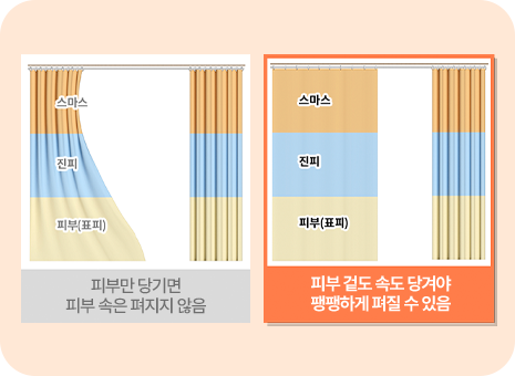 유지인대 제거 후 트리플 고정