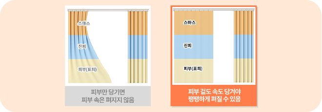 유지인대 제거 후 트리플 고정