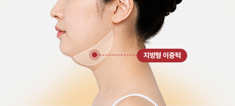 아이디병원 - 지방형 이중턱 - 리프팅