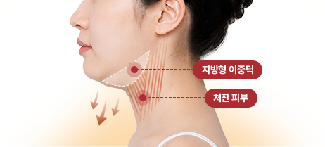 아이디병원 - 지방형 이중턱, 처진 피부 - 리프팅