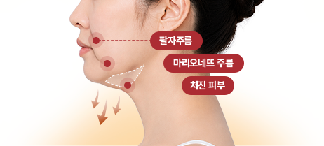 아이디병원 - 팔자주름, 마리오네트 주름, 처진 피부 - 리프팅