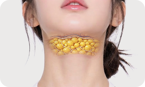 아이디병원 - 이중턱 리프팅 수술방법 - 정밀한 지방흡입 - 리프팅