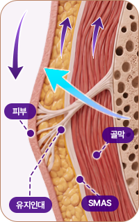아이디병원 - 중안부 리프팅 - 심부층부터 당겨 올림 - 리프팅
