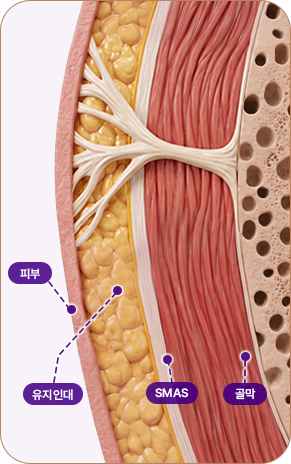 아이디병원 - 중안부 리프팅 - 심부층까지 리프팅 된 모습 - 리프팅