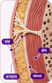 아이디병원 - 중안부 리프팅 - 심부층까지 리프팅 된 모습 - 리프팅