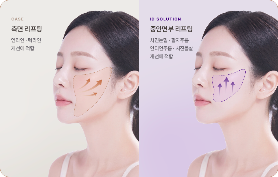 아이디병원 - 측면 리프팅과 중안면부 리프팅 방향 비교 - 리프팅