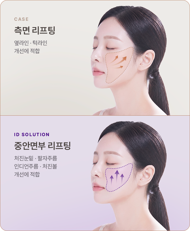 아이디병원 - 측면 리프팅과 중안면부 리프팅 방향 비교 - 리프팅
