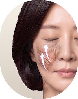 아이디병원 - 중안부 리프팅 수술방법 - 심부층 리프팅 - 리프팅