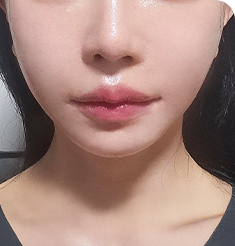 아이디병원 - 마리오네트, 팔자 주름, 처진 턱선 - After - 리프팅