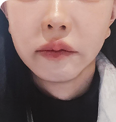 아이디병원 - 마리오네트, 팔자 주름, 처진 턱선 - Before - 리프팅