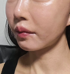 아이디병원 - 마리오네트, 팔자 주름, 처진 턱선 - Before - 리프팅