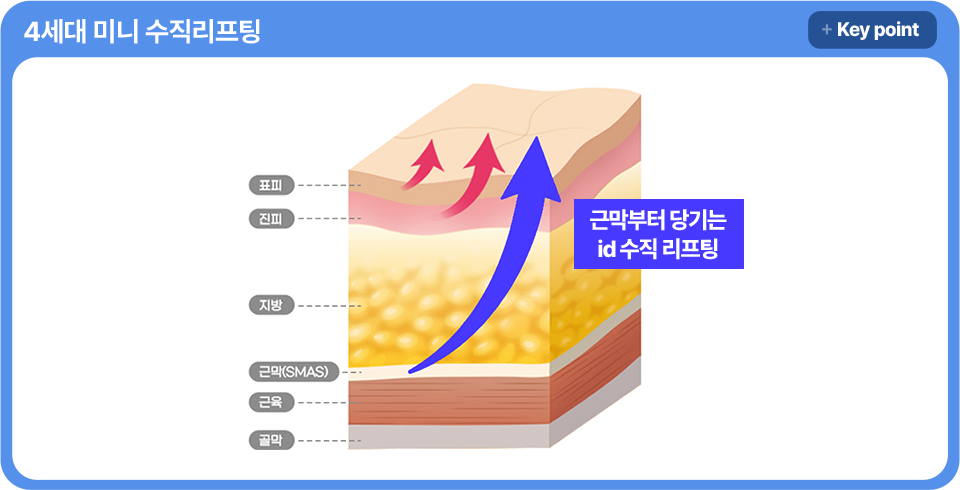 아이디병원 - 4세대 미니 수직리프팅 - 근막부터 당기는 id 수직 리프팅 - 리프팅
